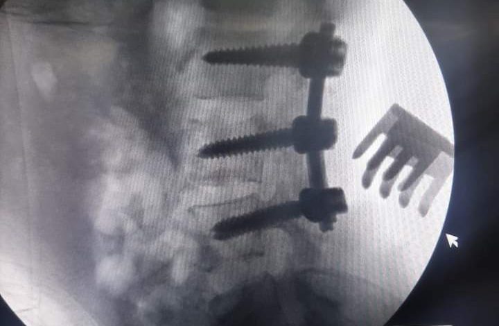 تثبيت كسر بالفقرات القطنية بالعمود الفقرى وتوسيع القناة الشوكية مع اصلاح ورتق تهتك بالام الجافية